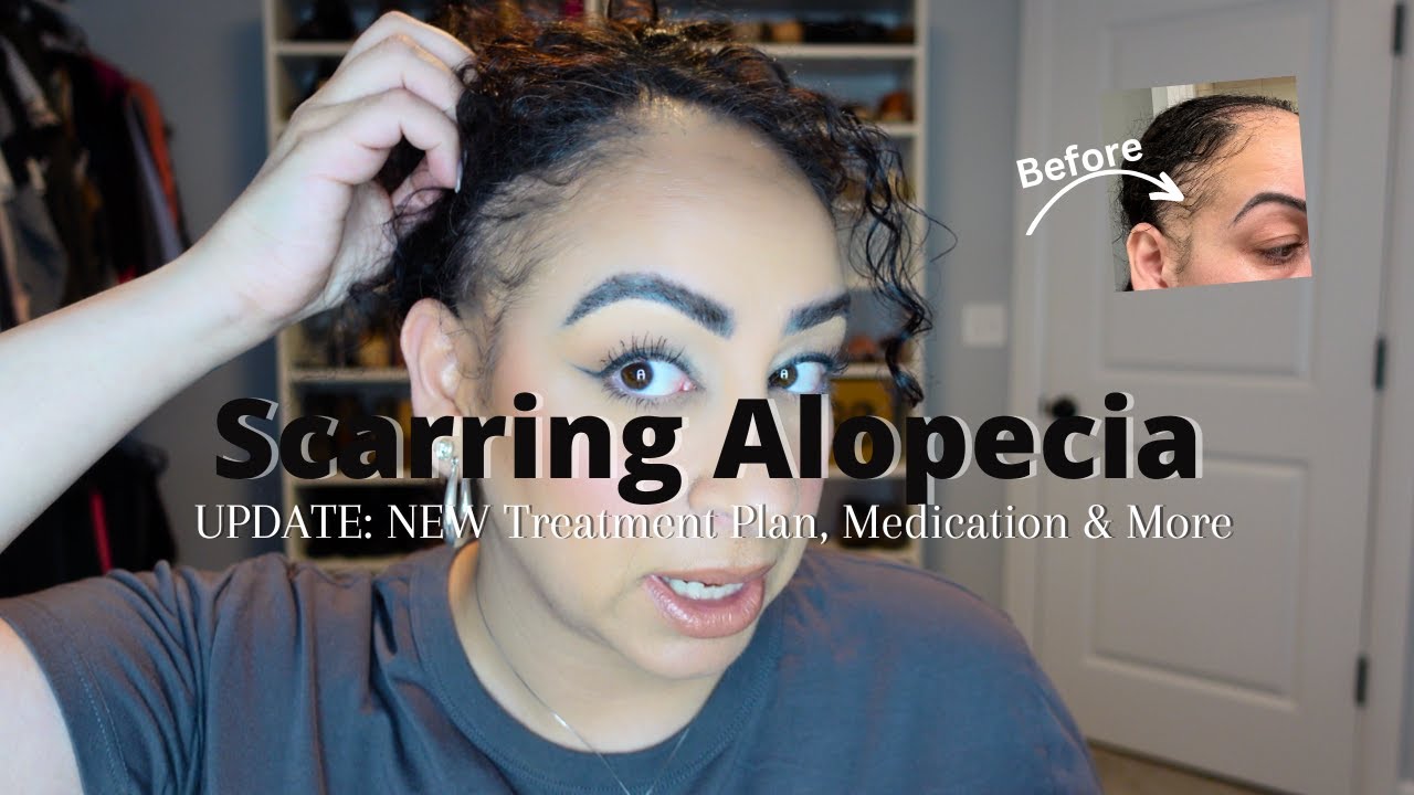 Scarring Alopecia UPDATE | NEW Treatment Plan, Medication & More