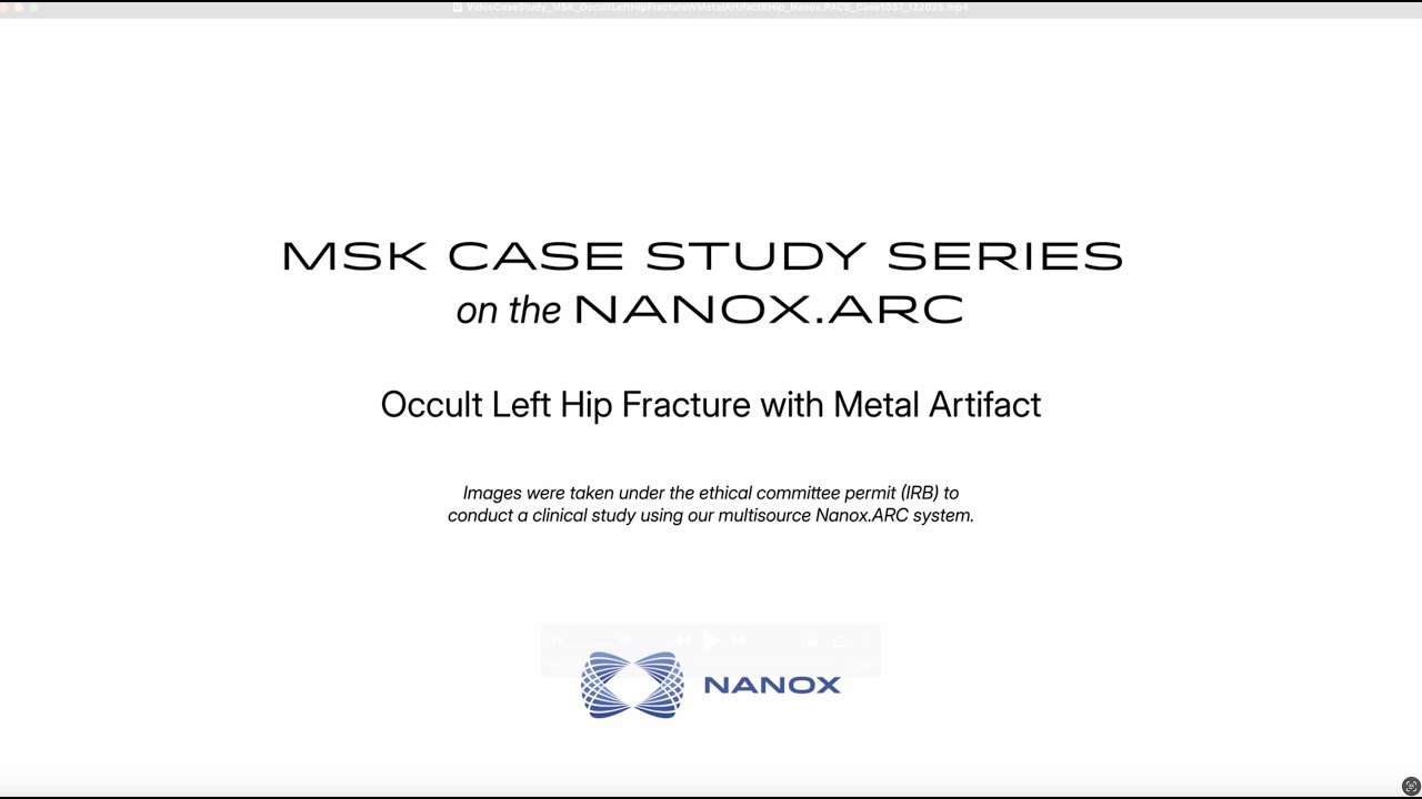 Clinical Case Study | Occult Left Hip Fracture with Metal Artifact | Nanox Vision