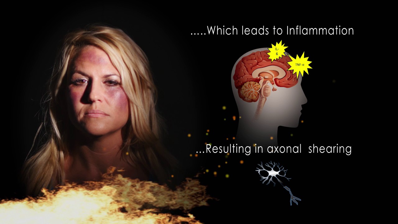 Another TBI