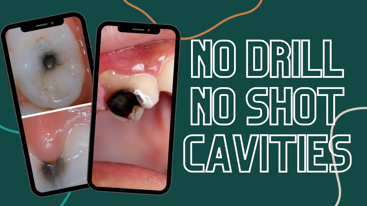 No Drill, No Shot Cavities?! #shorts