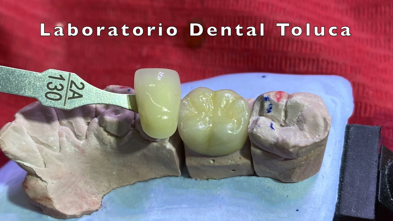 ELABORACION DE CORONA METAL PORCELANA PASO A PASO