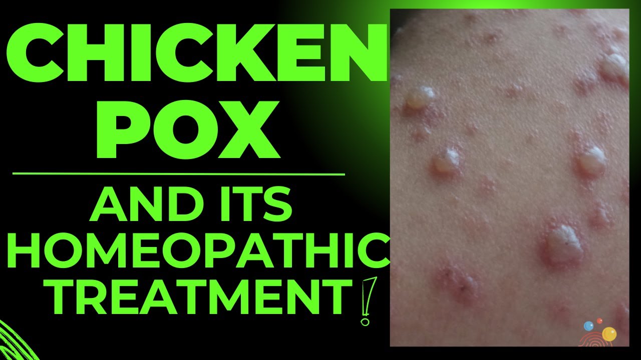 CHICKEN POX || BEST HOMEOPATHIC MEDICINE FORNCHICKEN POX || HOMEOPATHIC MEDICINE FOR CHICKEN POX ?
