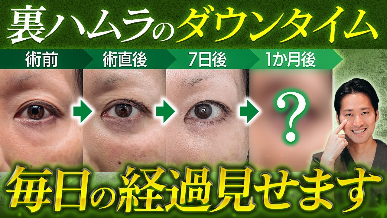 【毎日の経過大公開】裏ハムラのダウンタイム5症例徹底解説 ”失敗しないためのポイント”とは？