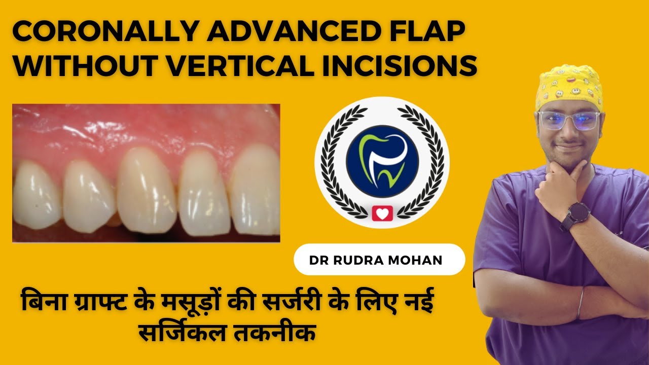 Dr Rudra Mohan |गम छोड़ने के इलाज की नई सर्जिकल तकनीक|Coronally Advanced Flap(No Vertical Incisions)