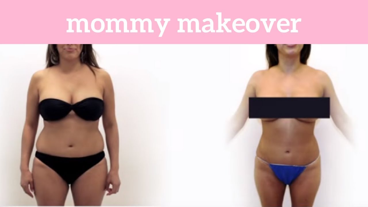 Stacy Visits Lift MD Aesthetics for a Mommy Makeover and  Liposuction with Vaginal Rejuvenation