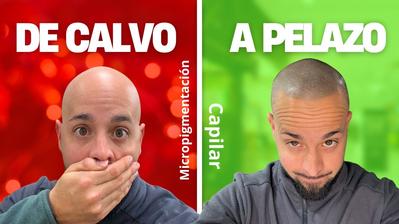 De calvo a pelazo. Micropigmentación capilar.