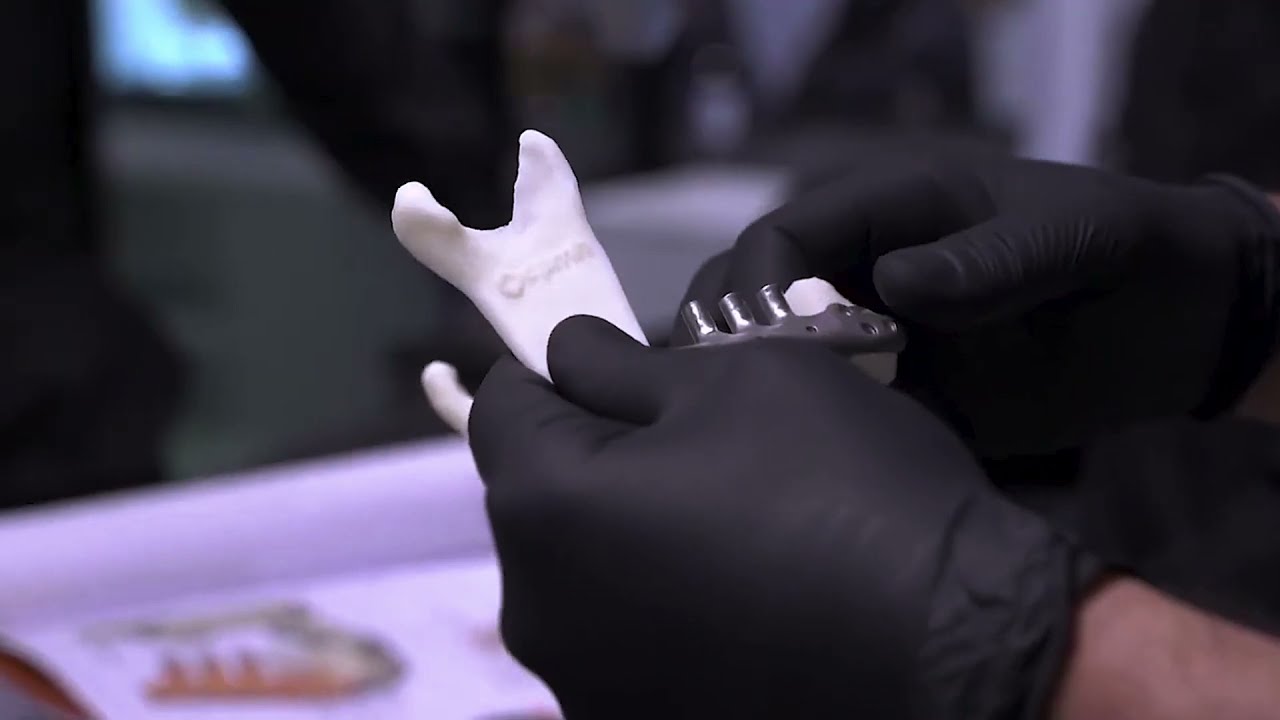Você já viu uma prótese de titânio para reconstrução mandibular?
