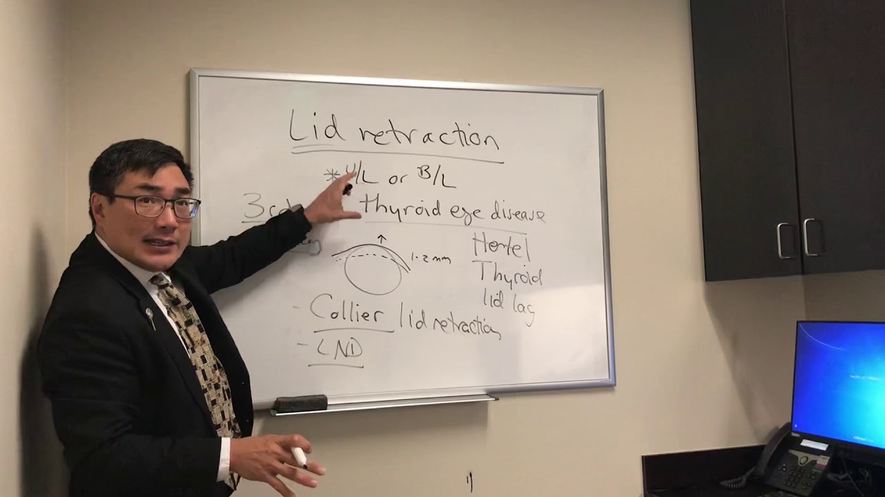 Lid Retraction in Neuro-op