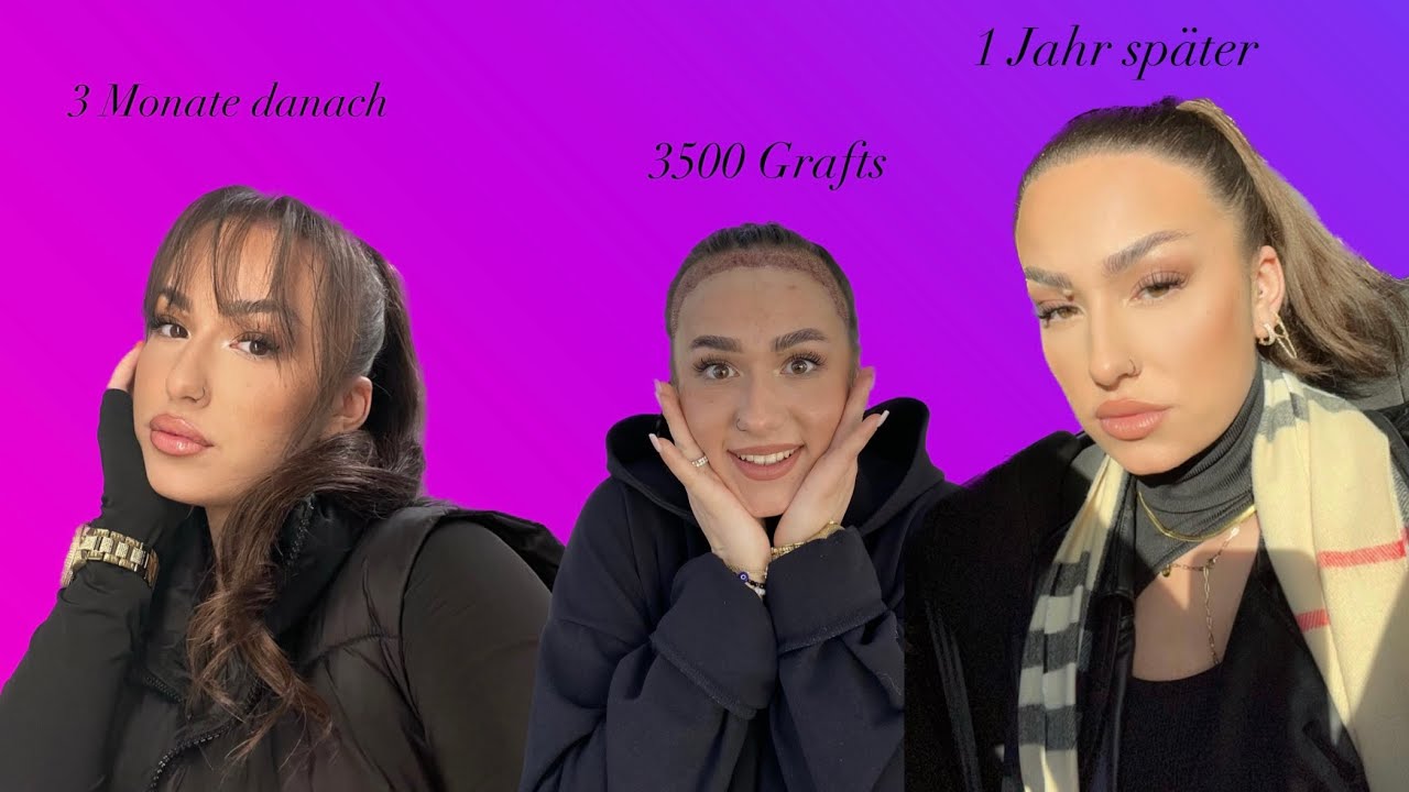 1 Jahr nach der Haartransplantation mit 3500 Grafts