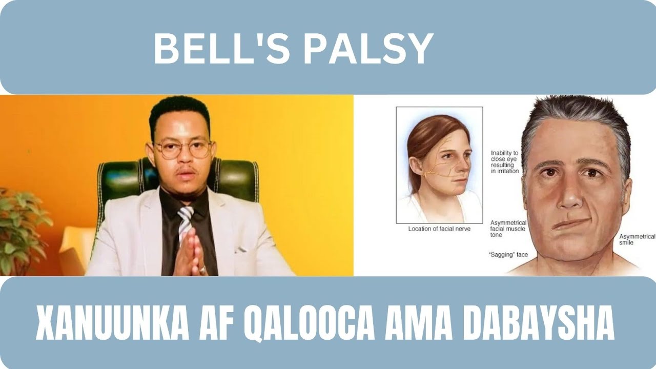 Bell's Palsy (Xanuunka Shimbirta ama afqalooca ) Dr. Ayanle Ali Mohamoud