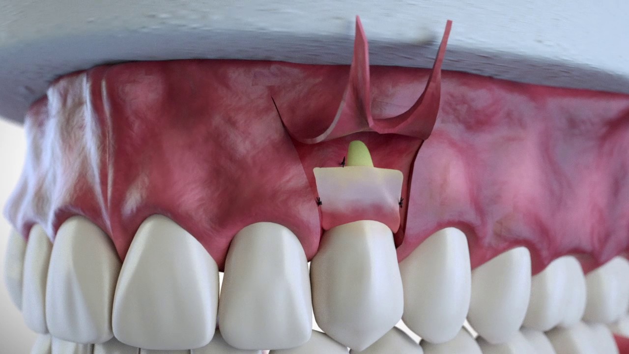 Subepithelial Connective Tissue Grafting