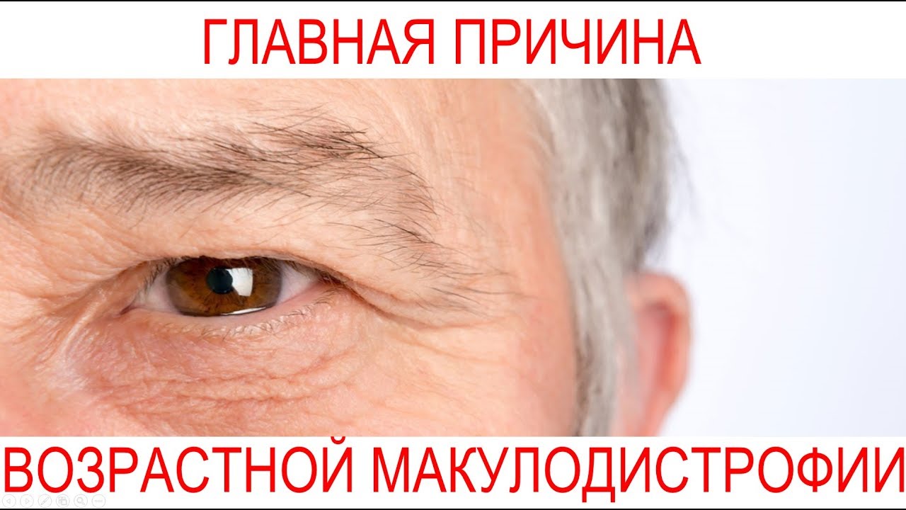 Причина возрастной макулодистрофии. Центр Ока