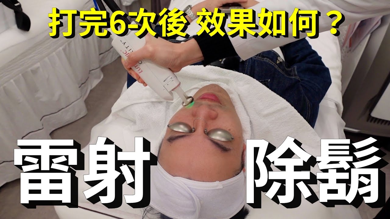 雷射除鬍實測 打完真的以後再也不用刮鬍子？