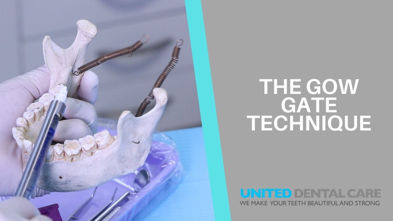 The Bony and Soft Tissue Landmark of The Gow Gate Technique