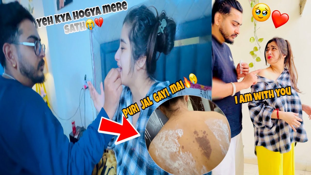 I got badly burned 🔥My back is ￼totally Injured 😭💔 | Mera sath hi yee sab kyu hota hai😢??