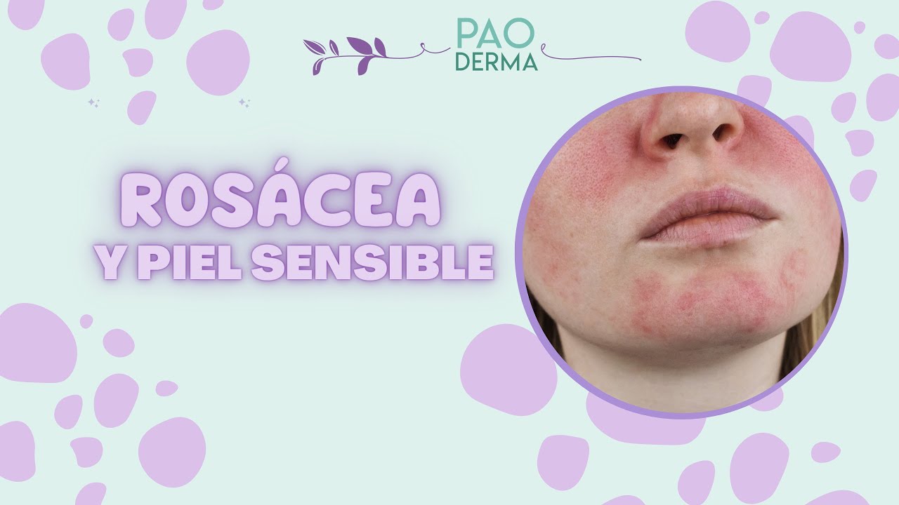 ROS&Aacute;CEA Y PIEL SENSIBLE
