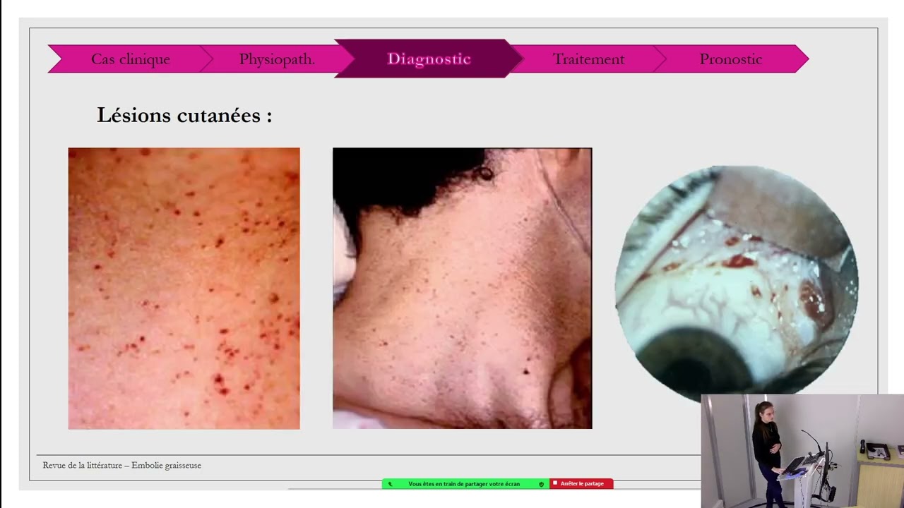 Embolie graisseuse par le Dr Julie Arnauld