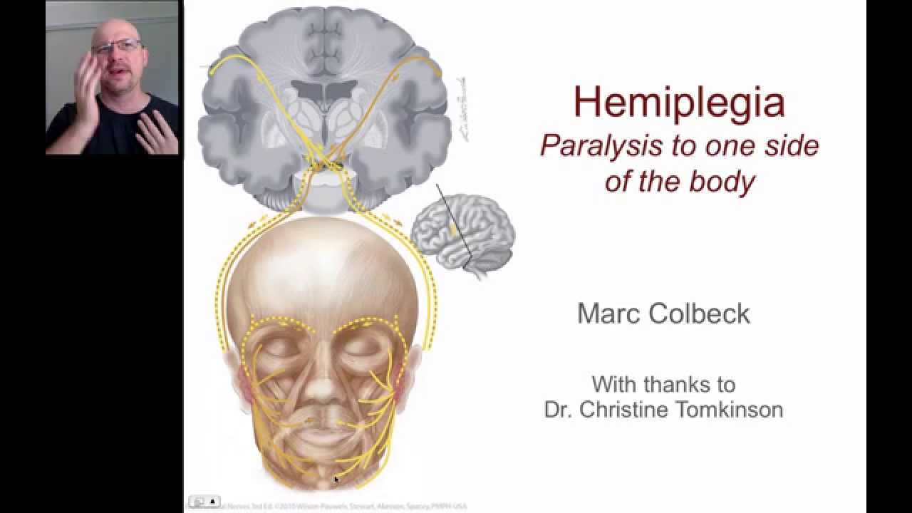 Hemiplegia 1