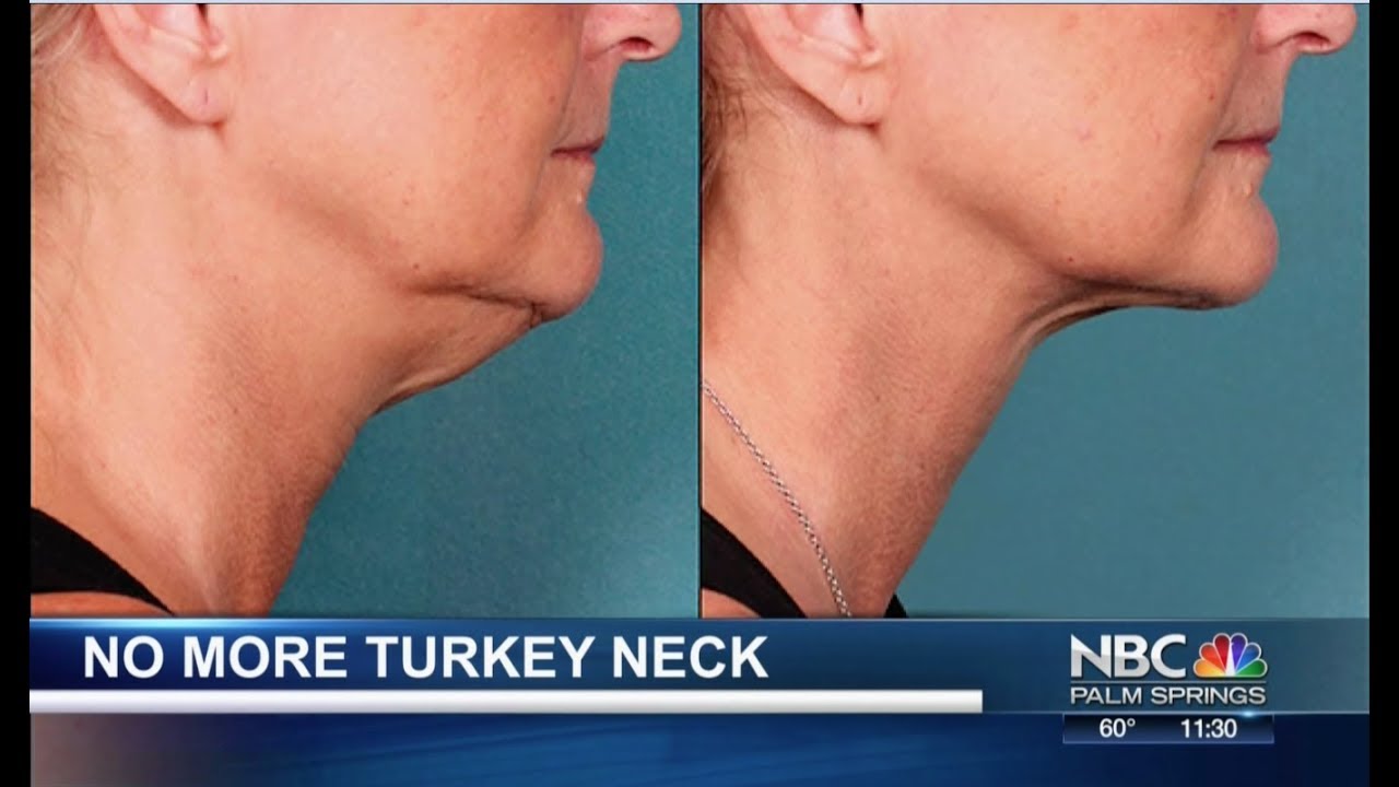 Solving the Turkey Neck problem, Dr Timothy Jochen
