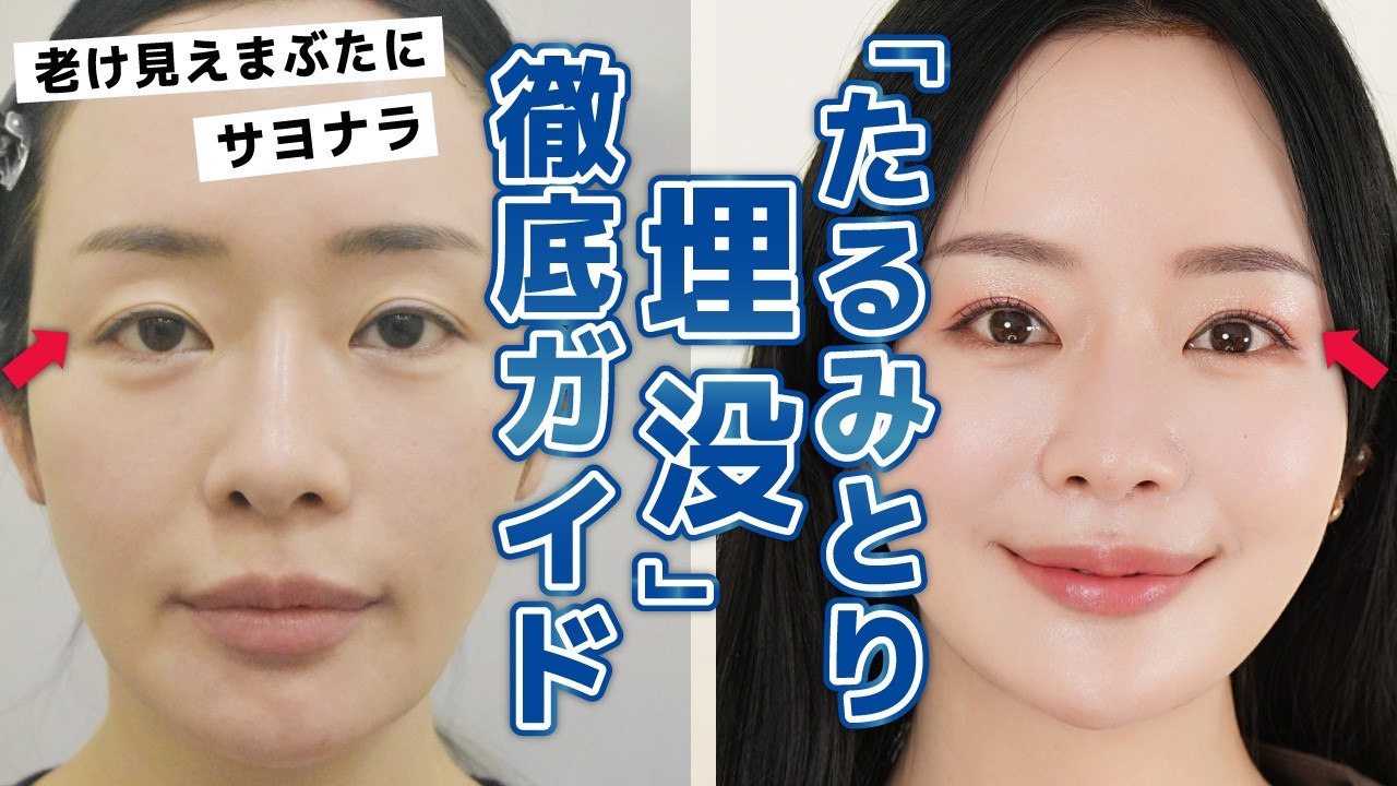 【たるみ取り埋没で若返り】まぶたに劇的変化！40・50代の埋没のポイント&注意点を徹底解説【執刀医・DTも公開】