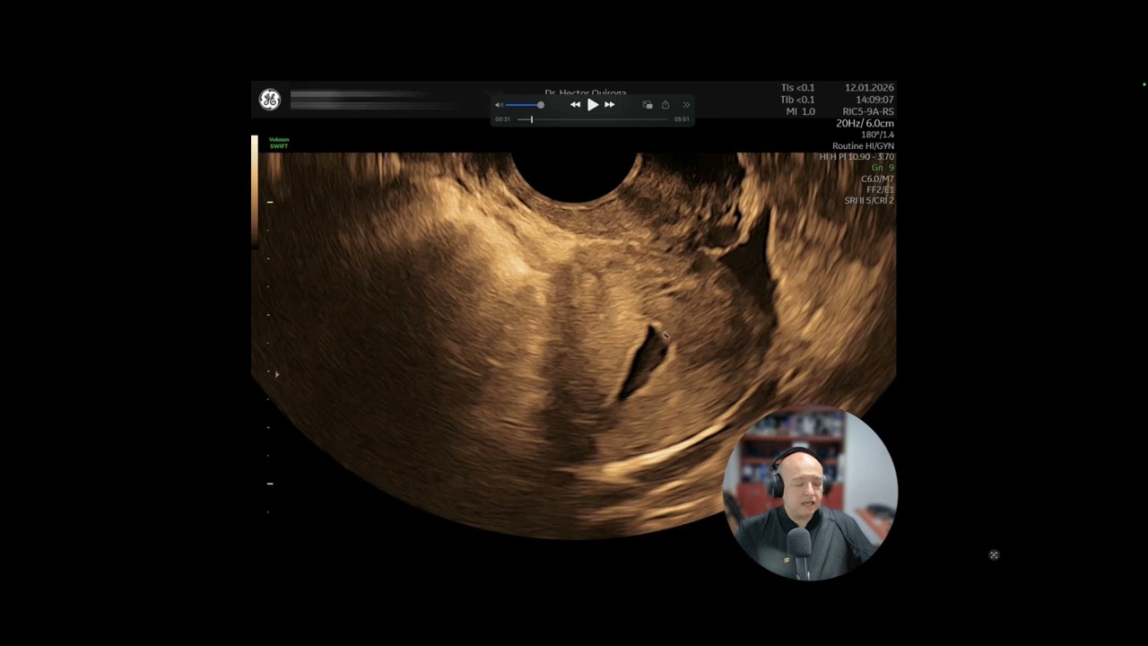 Litiasis Ureteral confundida con patología ginecológica.