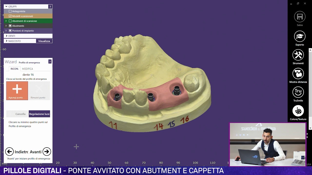 Ponte avvitato con abutment e cappetta