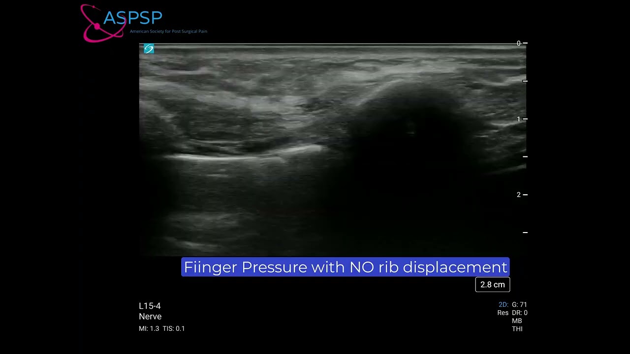 Dynamic Ultrasound to Diagnose Slipping Rib Syndrome