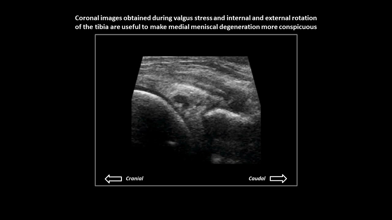 Meniscal degeneration (not tear) on dynamic knee ultrasound