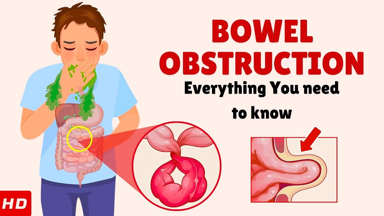 Bowel Obstruction &ndash; Causes, Signs and Symptoms, Diagnosis & Treatment