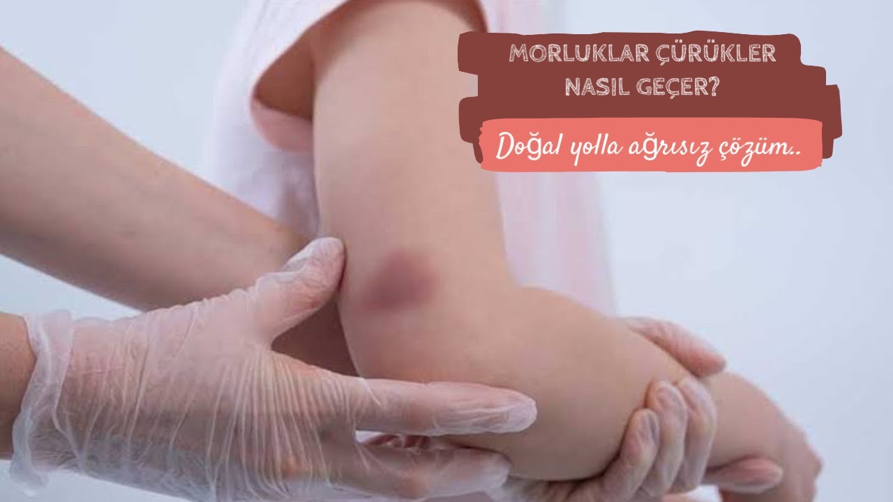 Morluk neden olur, nasıl ge&ccedil;er? V&uuml;cutta oluşan morluklara ne iyi gelir?