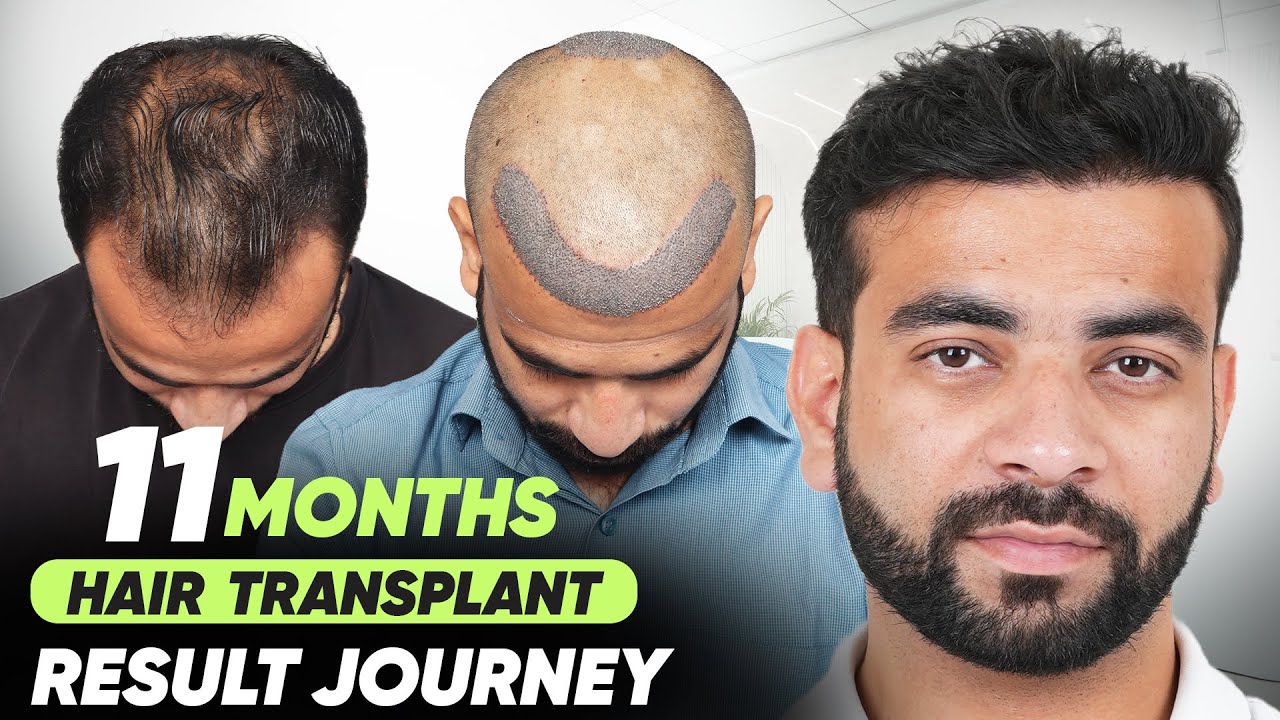 Hair Transplant in Patna (HX-GGER) | Best Results & Cost of Hair Transplant in Patna.
