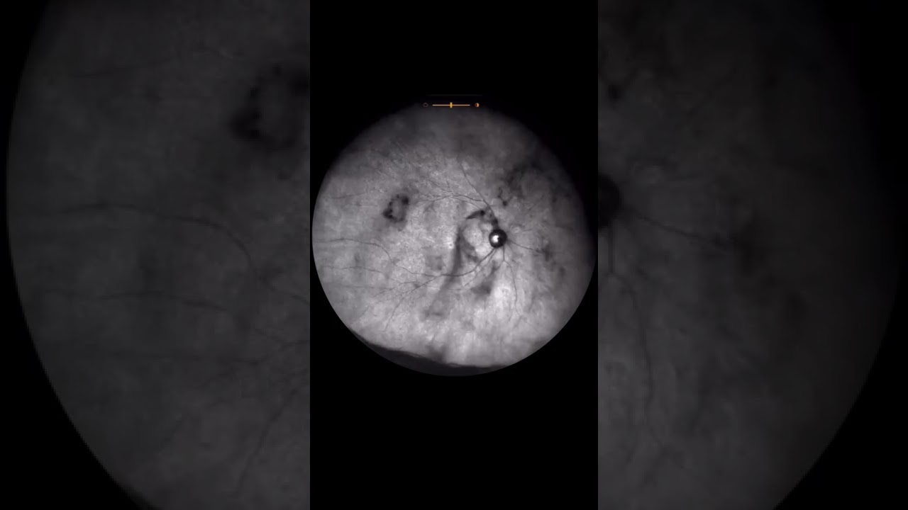 Vitreous Opacities | Eye Floaters #shorts