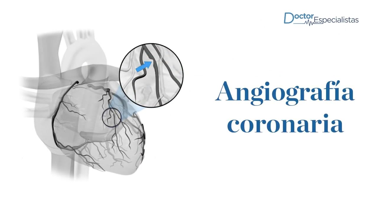 Angiografia coronaria - Doctores Especialistas