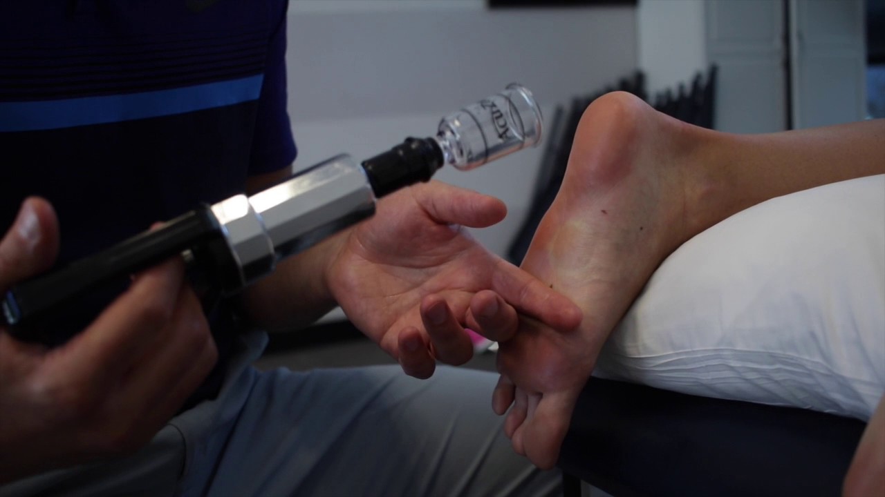 Cupping Treatment for Foot Pain- Explained by Dr. Eric Hefferon of Impact Physical Therapy