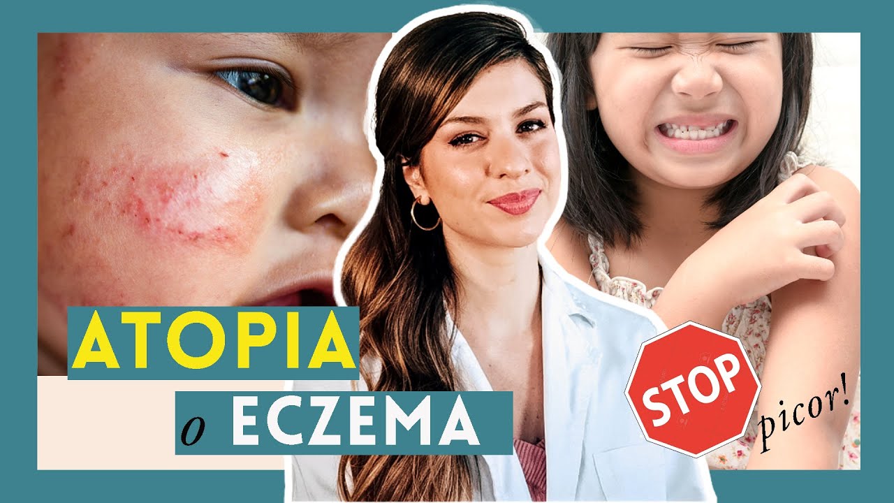 ✦ Piel ATÓPICA (o eccema) en BEBÉS y NIÑOS. Cuidados y tratamiento del brote de dermatitis atópica