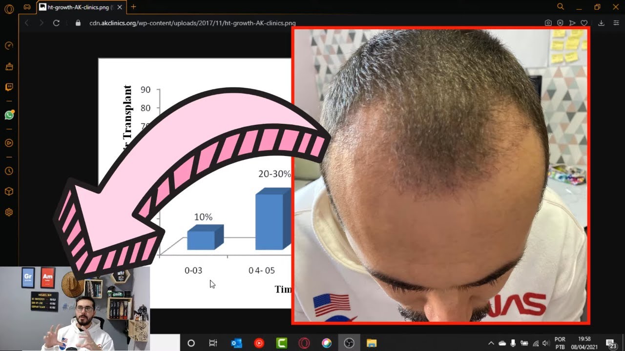 EVOLUÇÃO / CRESCIMENTO DO CABELO PÓS TRANSPLANTE CAPILAR - VOCÊ SABE QUANTOS % CRESCER POR MÊS?