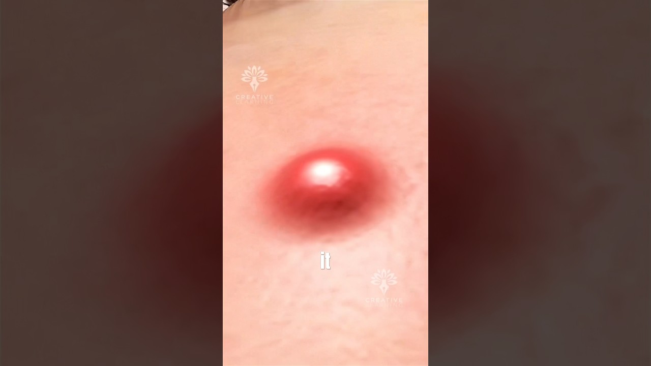 What&rsquo;s Really Trapped Inside a Pimple😮#acne #shorts