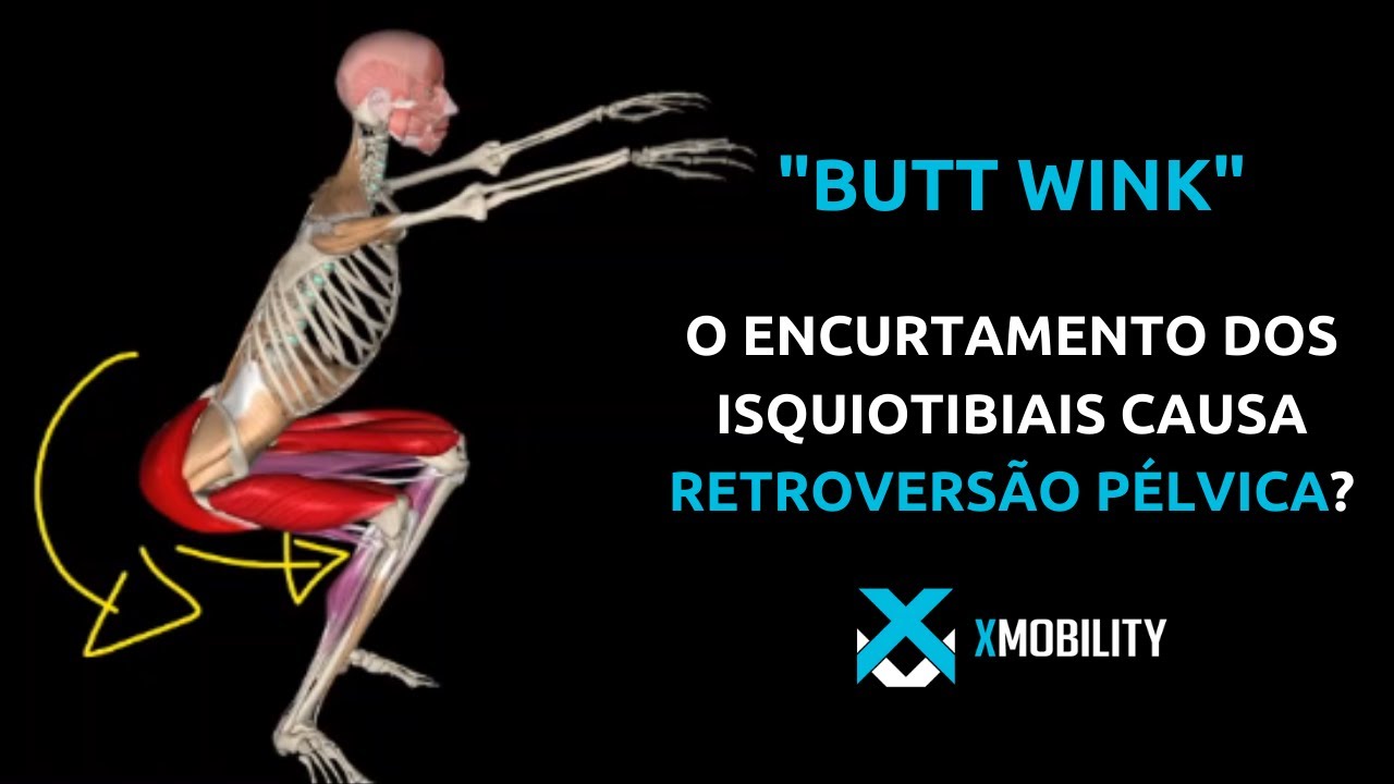O encurtamento dos isquiotibiais causa retroversão pélvica?