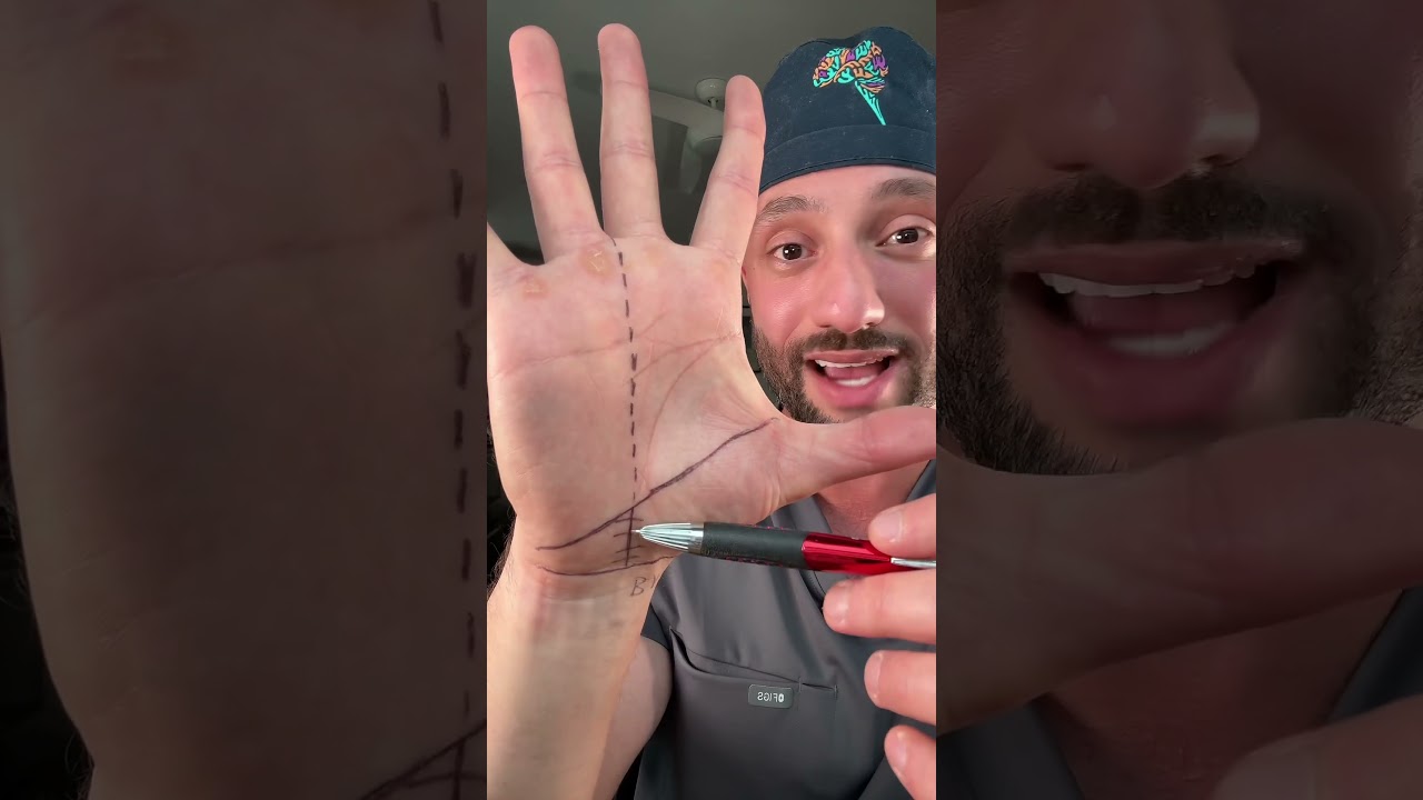 Planning an incision for carpal tunnel release. 🔪 
