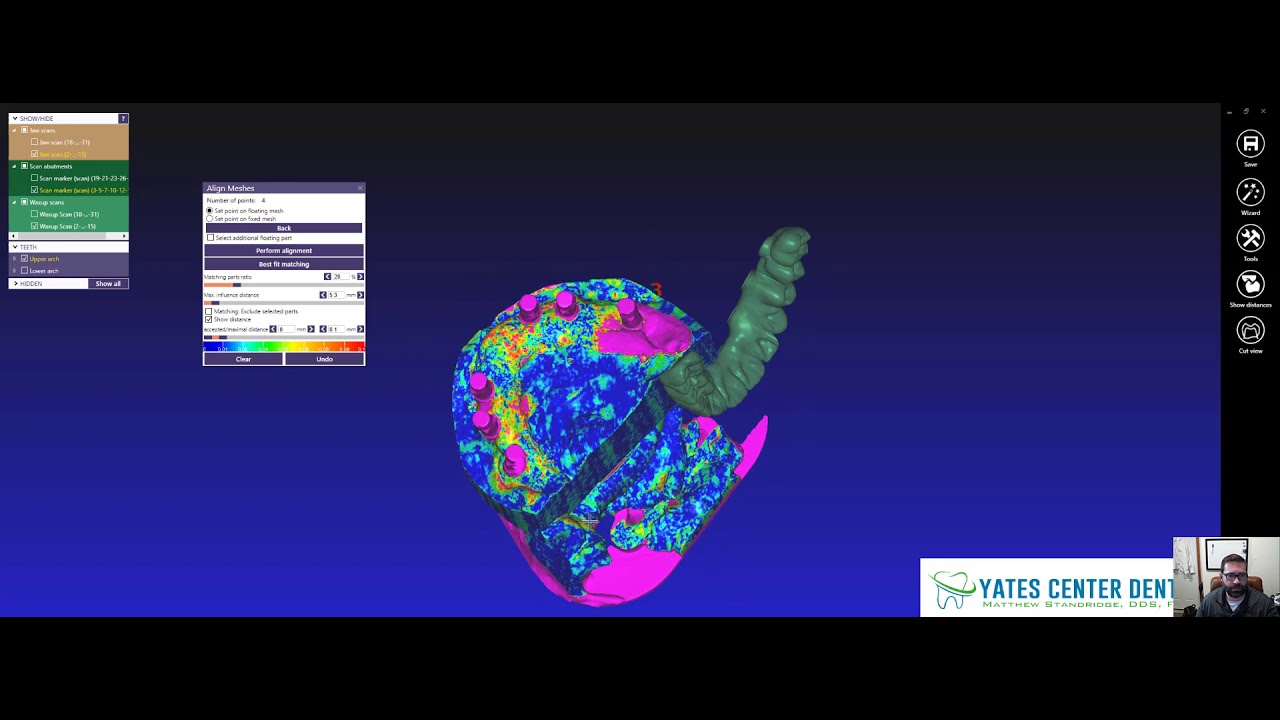 Aligning Meshes in Exocad