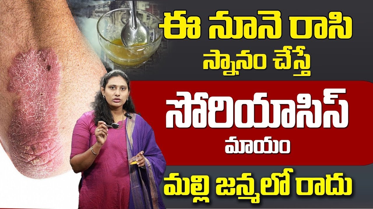 సోరియాసిస్ సమస్యలను తగ్గించడంలో సహాయపడే హోమ్ ఆయిల్ టిప్
