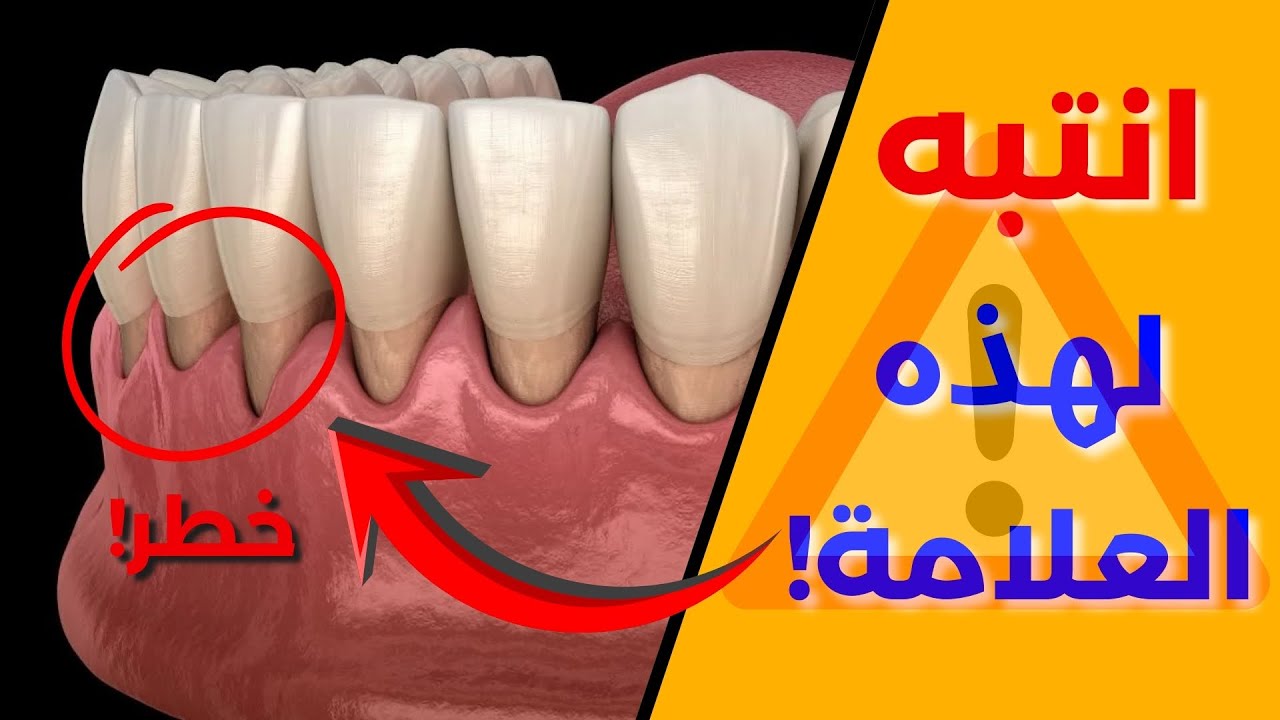 أسنانك صارت أطول؟ انتبه! هذا عرض انحسار اللثة🦷your teeth gotten longer? This is a gum recession