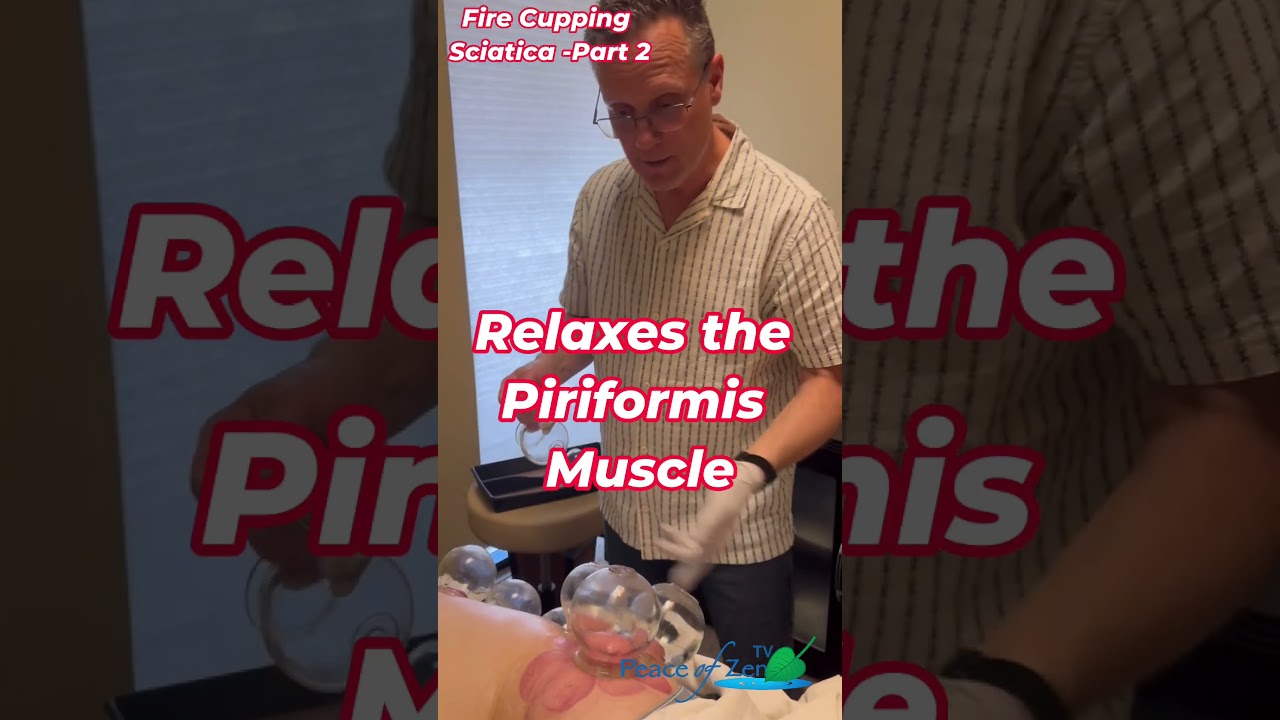 Cupping for  Sciatic & Low Back Pain Relief &ndash; Real Results in Just 20 Minutes!
