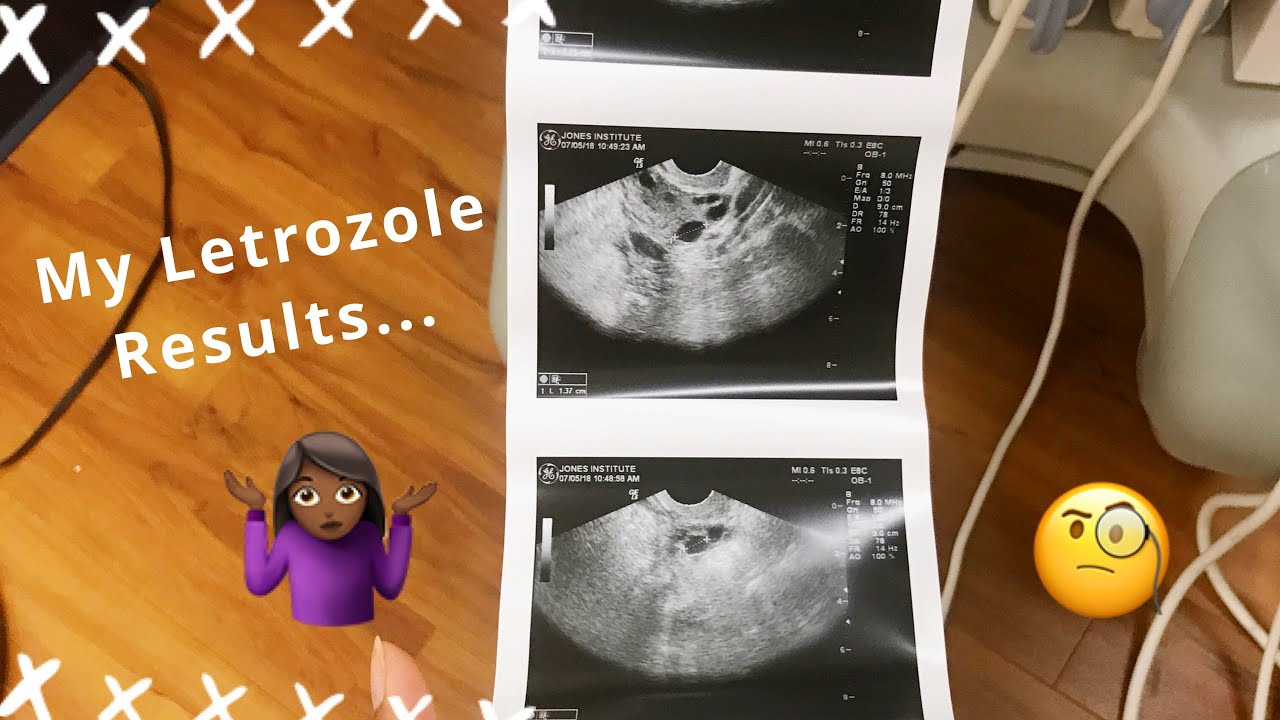 How I Responded To Letrozole/ Femara