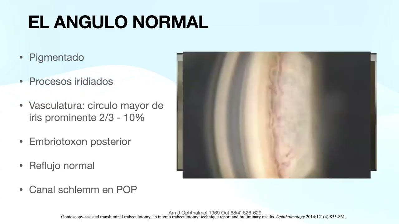 Gonioscopia una aproximación para el oftalmólogo - Dra. Natalia Agudelo