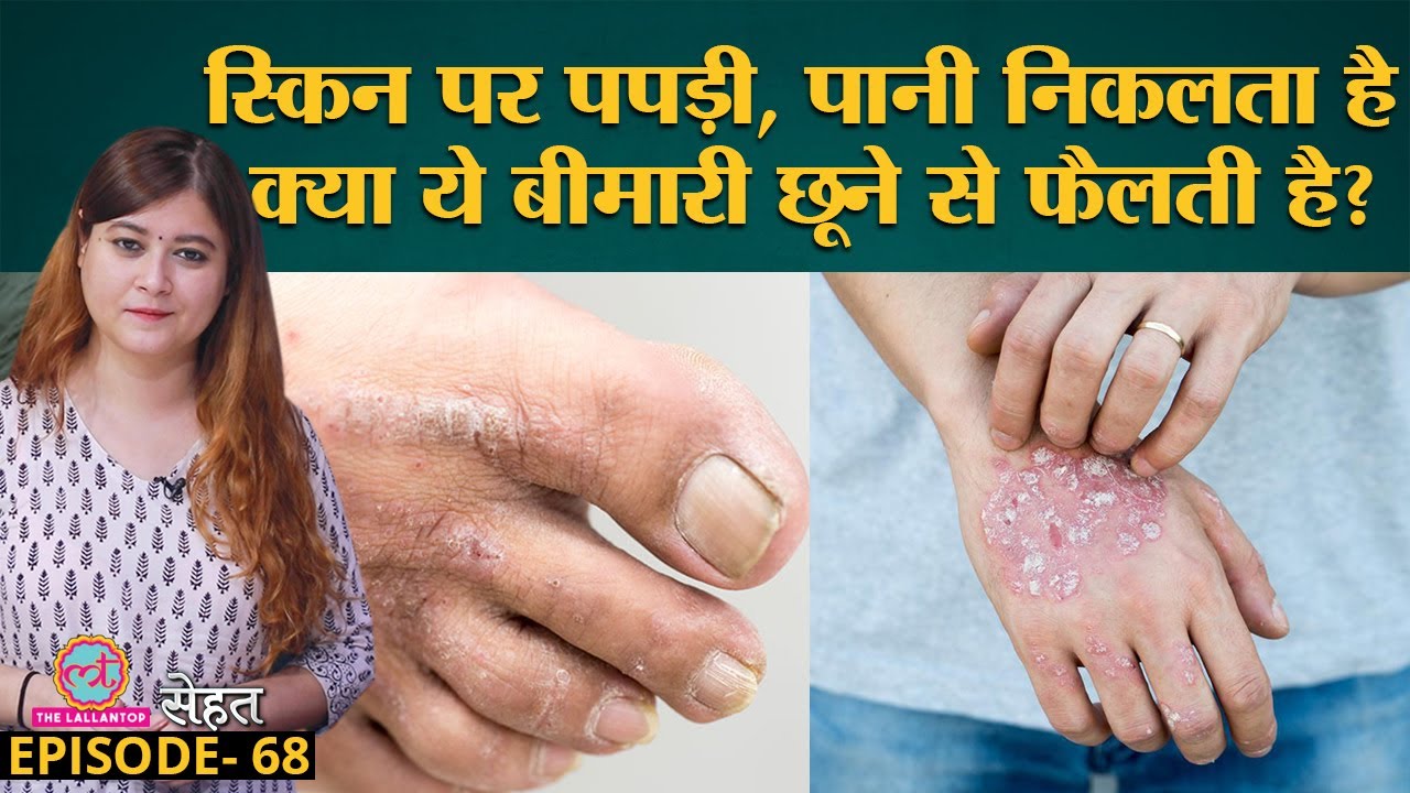 Eczema में Skin पर सफ़ेद पपड़ी, खुजली और पानी निकलने लगता है, ये काम हरगिज़ न करें  | Sehat Ep 68