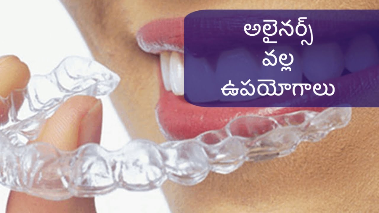 Aligners | benefits | Telugu
