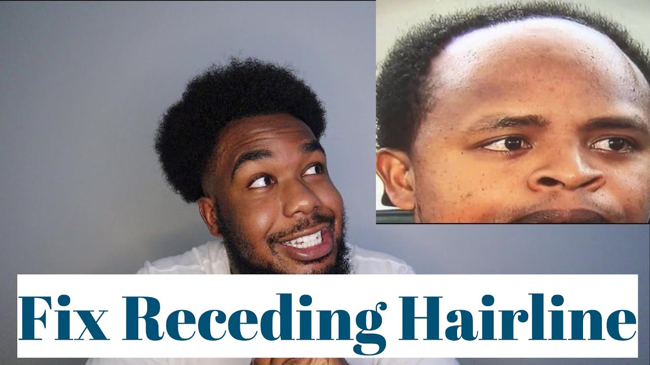 Fix your Receding Hairline