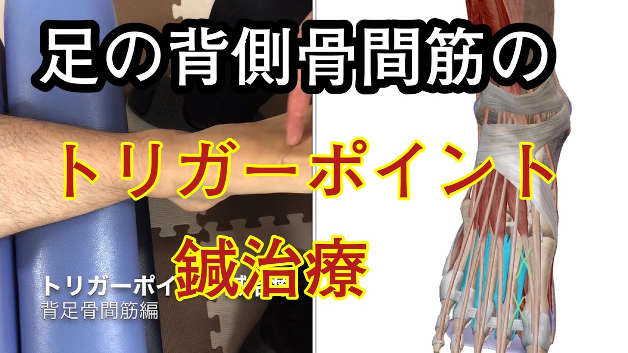 足の背側骨間筋のトリガーポイント鍼治療、指の痛みに