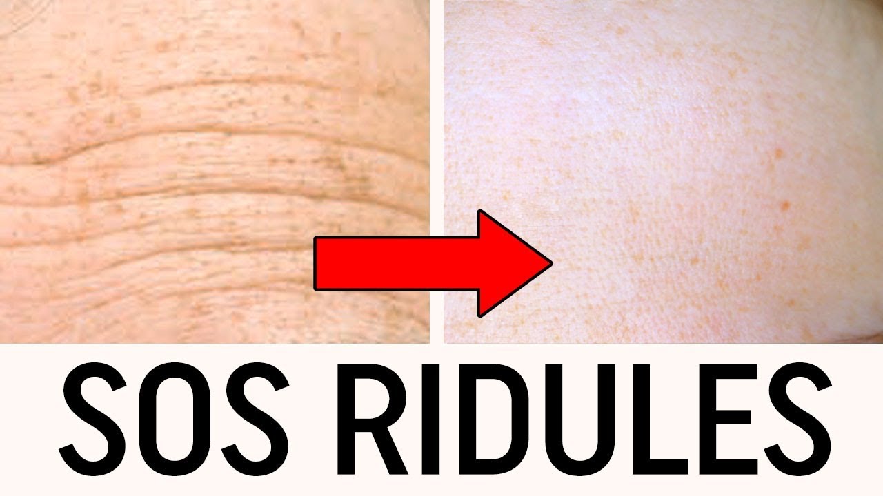 COMMENT DIMINUER LES RIDULES ?